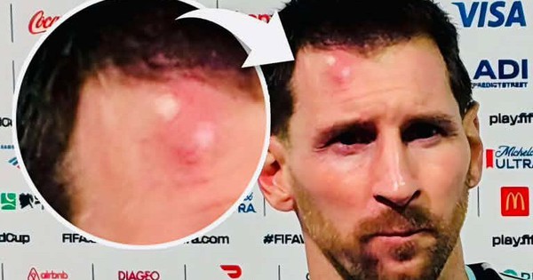 Messi sưng vêu trán sau trận thắng Cabo Verde: Vì sao nên nỗi? - hình ảnh - vipnohu90.com Messi sưng vêu trán sau trận thắng Cabo Verde: Vì sao nên nỗi? - hình ảnh - vipnohu90.com